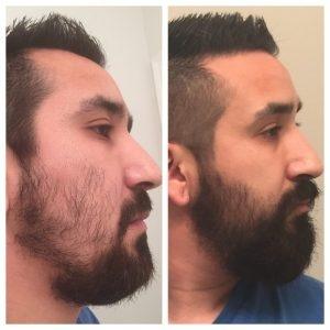 Muzzie reccomend Can d-35 help men grow facial hair