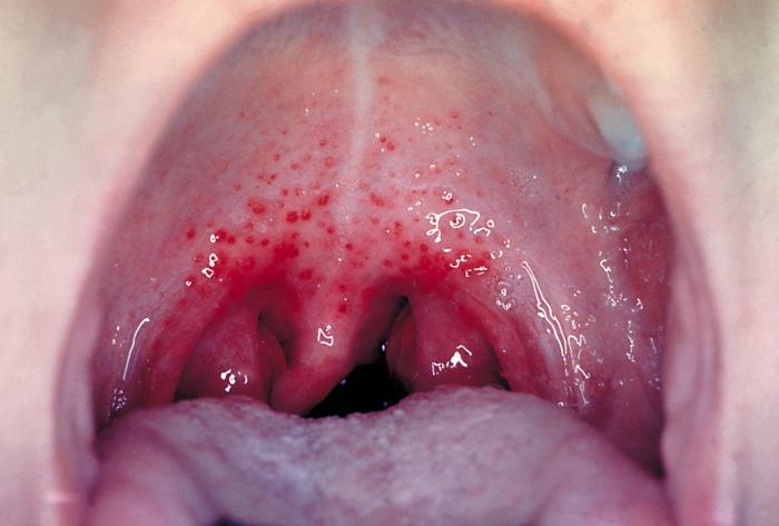 Pharyngeal gonorrhea and oral sex