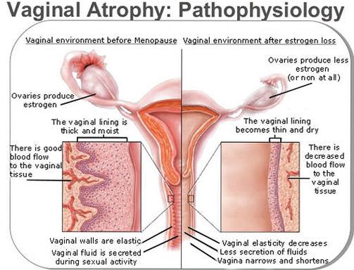 best of Menopause Dry vagina in