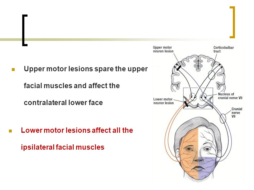 best of Motor facial Lower neuron