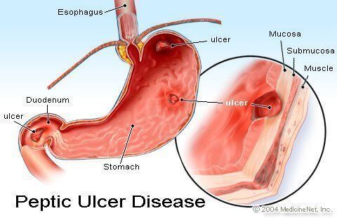 Difference between perforated and penetrate ulcers
