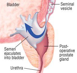Dry orgasm after prostatectomy