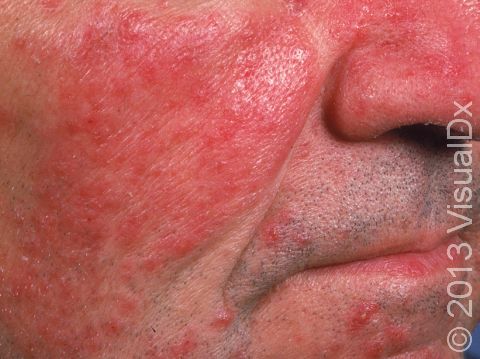 Facial rash differential diagnosis