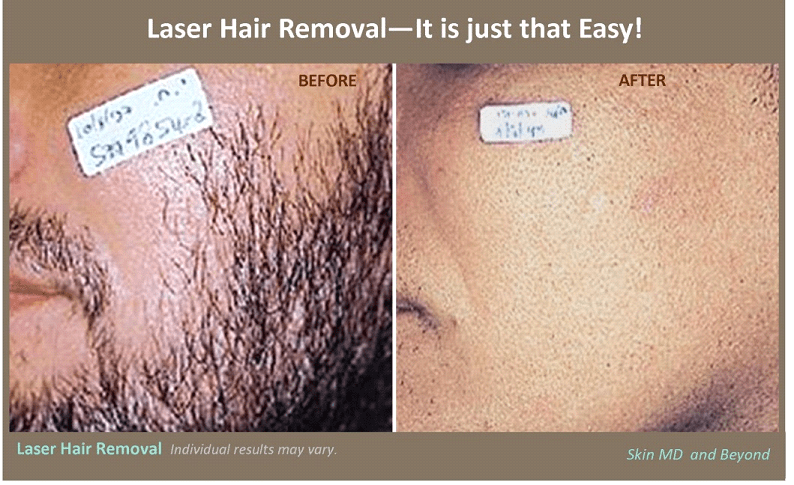 London reccomend Facial hair removal laser in montreal