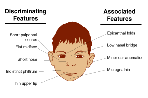 The C. reccomend Facial characteristics of fetal alcohol syndrome