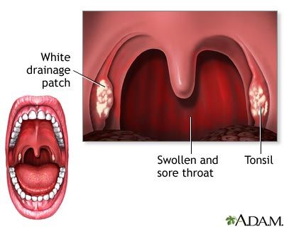 Adult strep throat symptoms