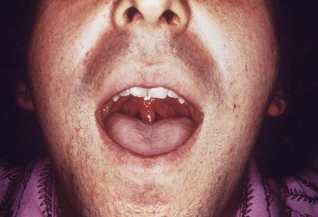 Queen C. reccomend Pharyngeal gonorrhea and oral sex