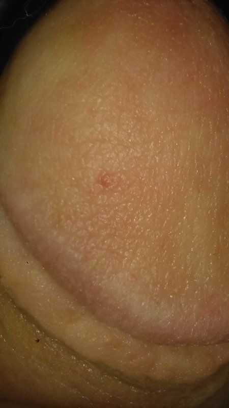 Red dots on head of penis