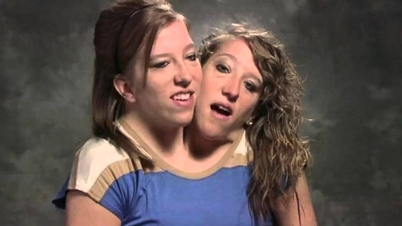 Vams reccomend Female adult siamese twins pictures