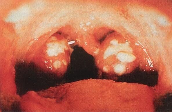 best of Gonorrhea oral Pharyngeal sex and