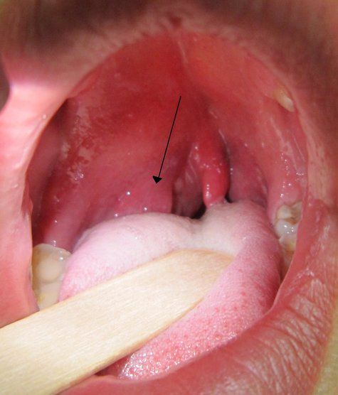 Quasar reccomend Pharyngeal gonorrhea and oral sex