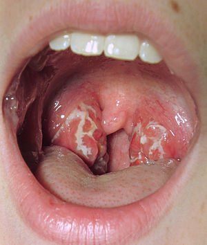 Snout reccomend Adult strep throat symptoms