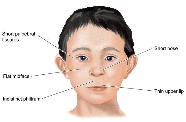 best of Fetal alcohol Facial syndrome of characteristics