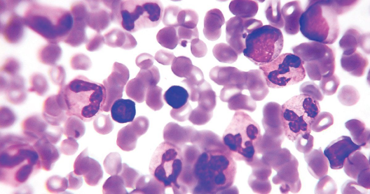Malignant tumor of mature lymphocytes