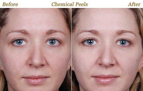 Governor reccomend Chemical facial louis peel st