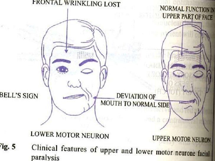 Cutlass reccomend Lower motor neuron facial