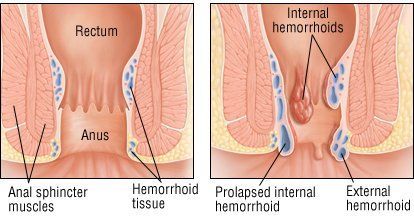best of Intercourse with hemmoroids Anal external