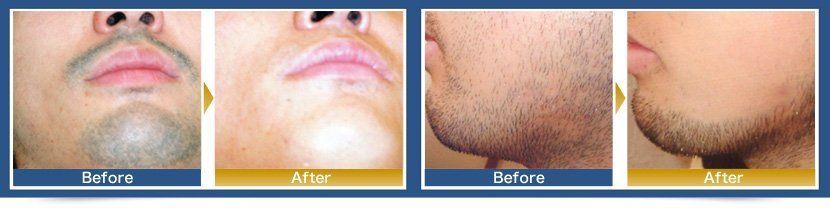 Wonder W. reccomend Male facial hair permanant removal