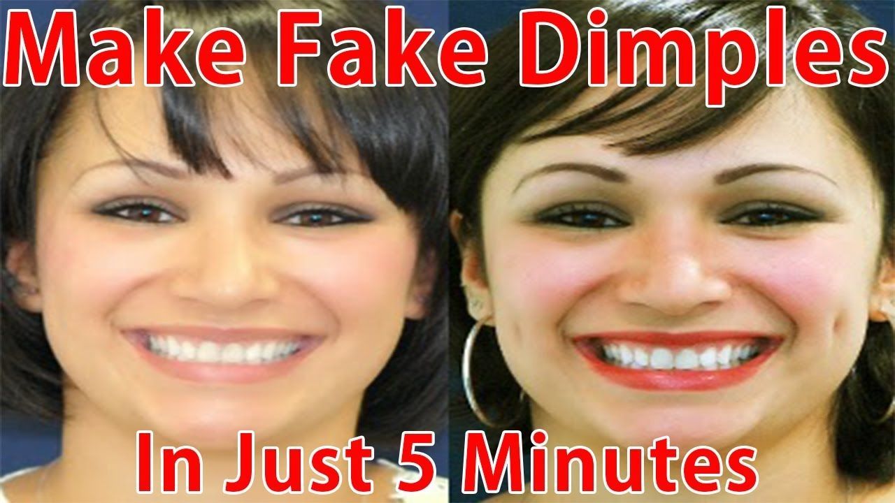 How are facial dimples formed