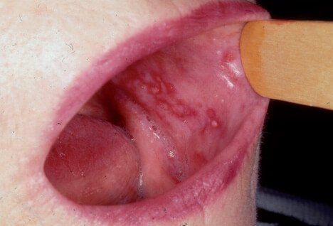 Scabies mouth