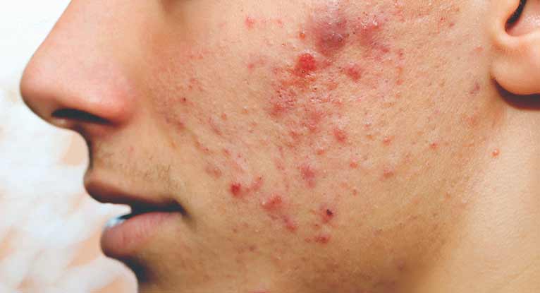 best of Acne to facial Is stds related
