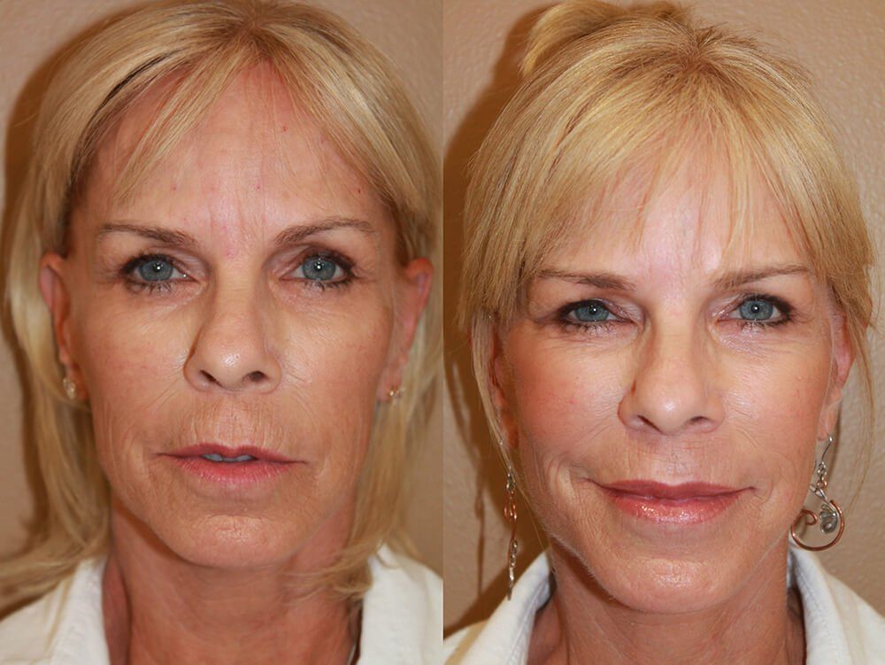 Flowerhorn reccomend Cosmetic facial fort lauderdale surgery