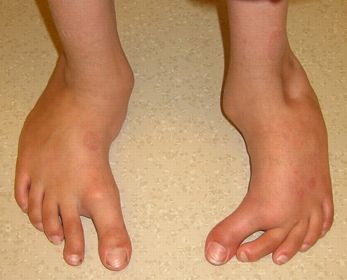 Cosmos reccomend Intoeing and foot pain in adults