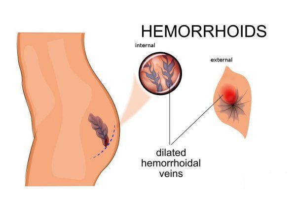 Anal intercourse with external hemmoroids