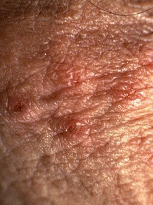 Anal vaginal blisters
