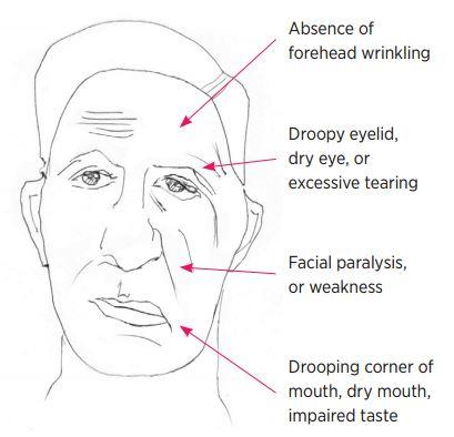 Edema facial paralysis hyperacusis excessive tearing