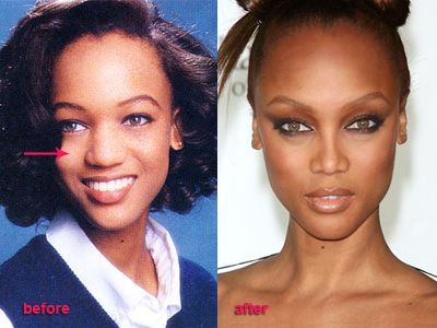 Tyra banks boobs Plastic Surgery Before And After: Tyra Banks