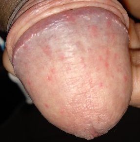 Red dots on head of penis