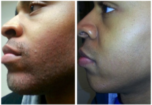 Male facial hair permanant removal