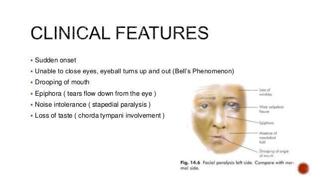 Edema facial paralysis hyperacusis excessive tearing