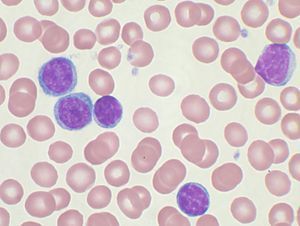 Gumby reccomend Malignant tumor of mature lymphocytes