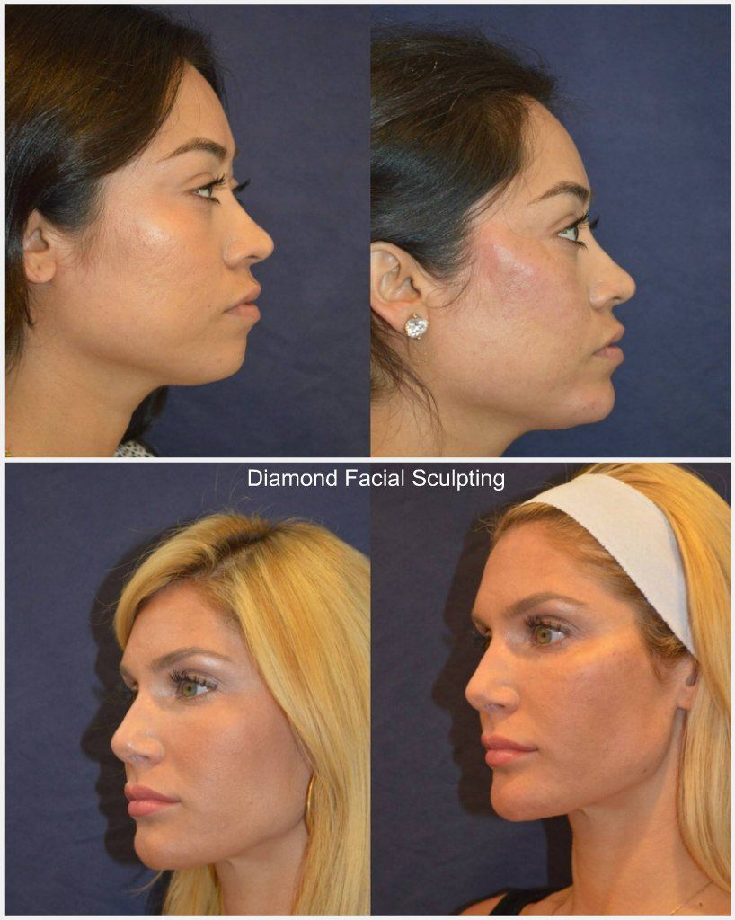 Sentinel reccomend Facial sculpting surgery