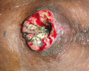Sore spots on anus