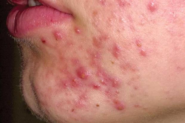 Peep reccomend Facial rash differential diagnosis