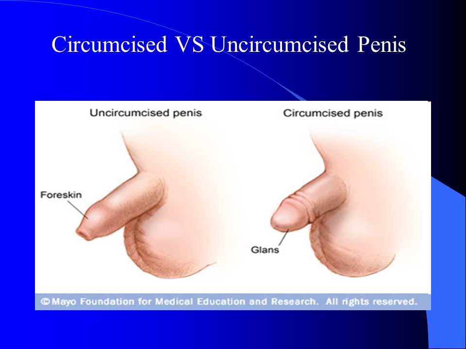 Circumcised penis vs uncircumcised . 