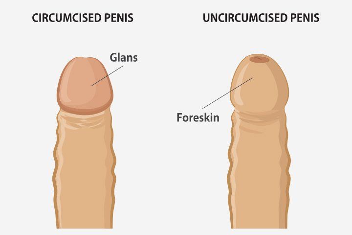 Circumcised penis vs uncircumcised 