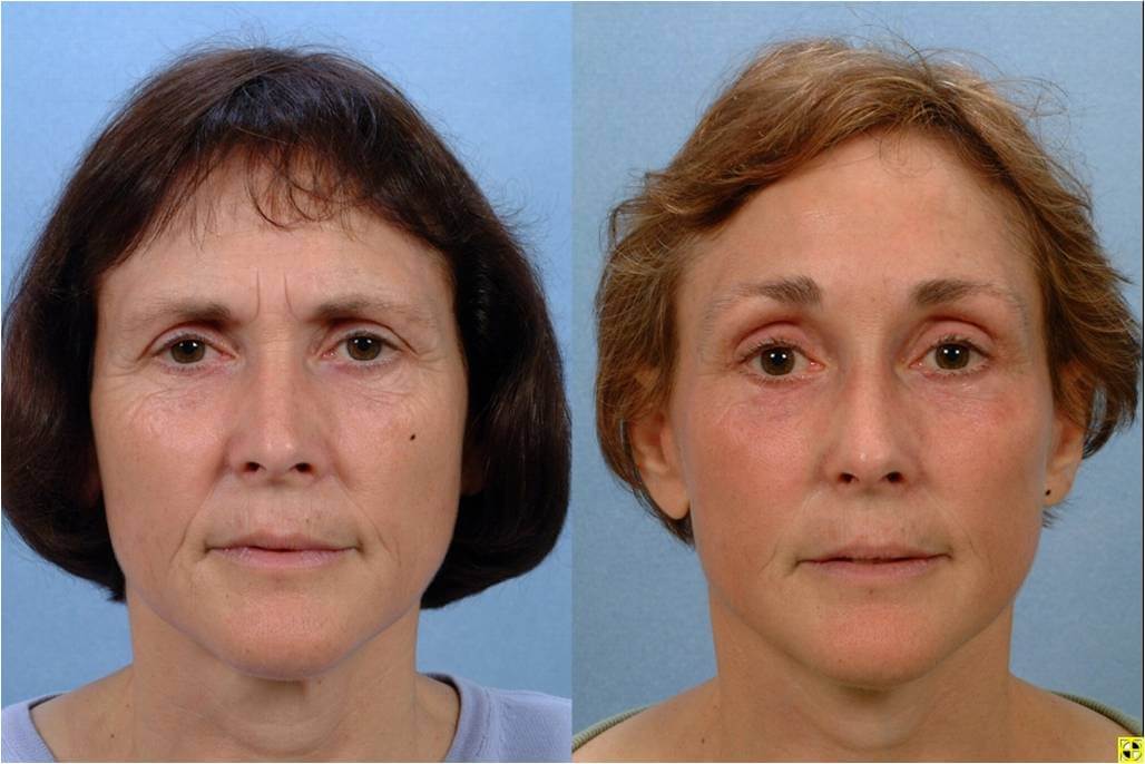 Black L. reccomend Cosmetic facial institute surgery