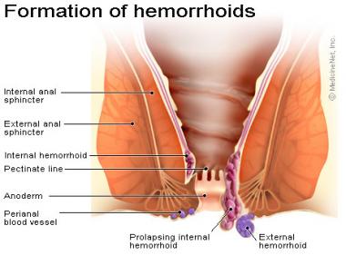 best of Intercourse with hemmoroids Anal external