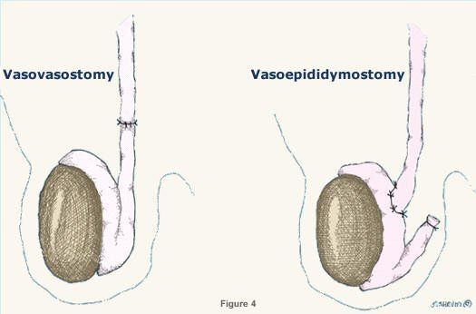 Sperm viability after vasectomy