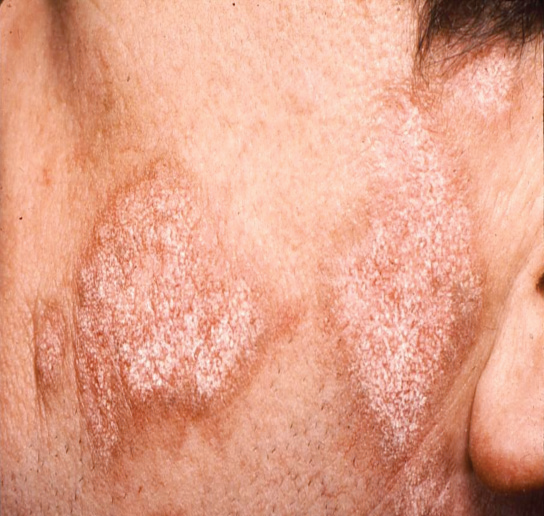 Brown S. reccomend Erythemic pruritic dry flaky facial rash