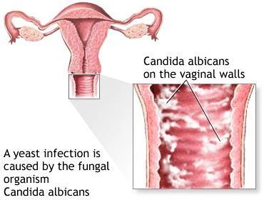 Fungal infection in vagina