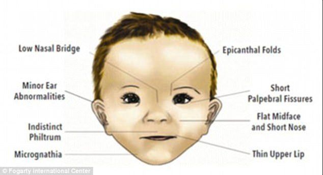 best of Fetal alcohol Facial syndrome of characteristics