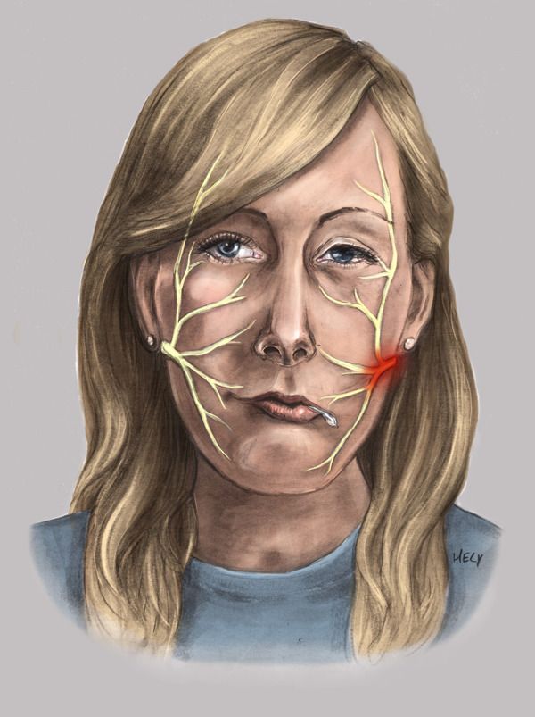 Facial pain of left side