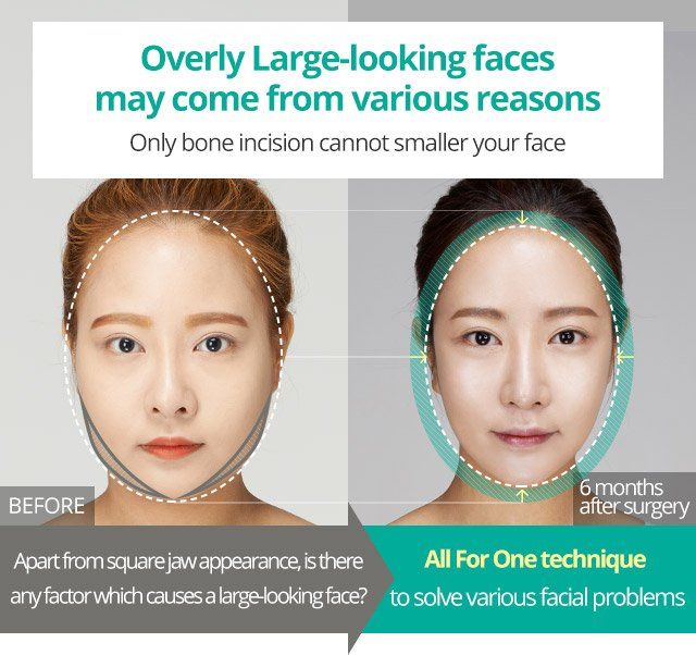 best of Surgery Facial sculpting