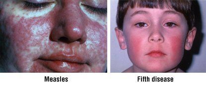 Facial swelling caused by stool softener