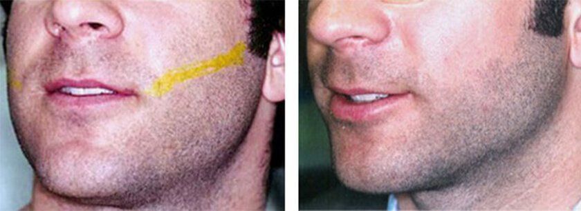 Supernova reccomend Male facial hair permanant removal